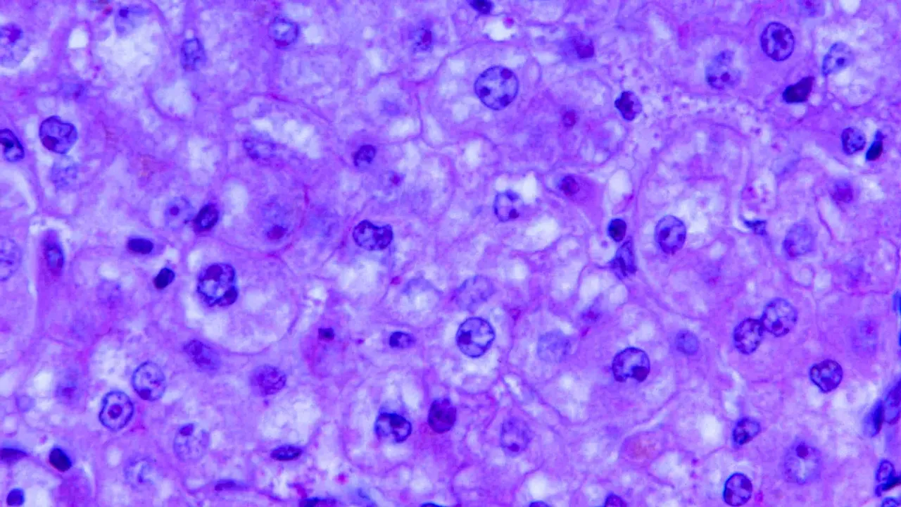 A 440X photomicrograph magnification of a hematoxylin and eosin (H&E)–stained liver tissue specimen, revealed the presence of cytoarchitectural changes in
